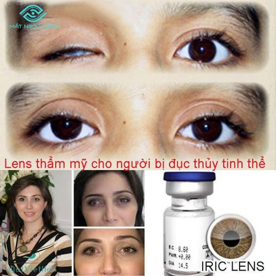 Lens thẩm mỹ